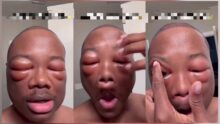 "I have 1% vision" — Man shows aftermath of his alleged hair transplant